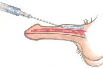 Dangerous method of penis enlargement by injecting petroleum jelly